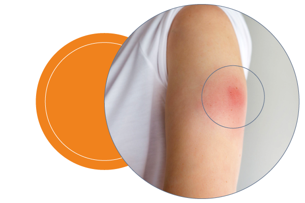 site reaction to injection