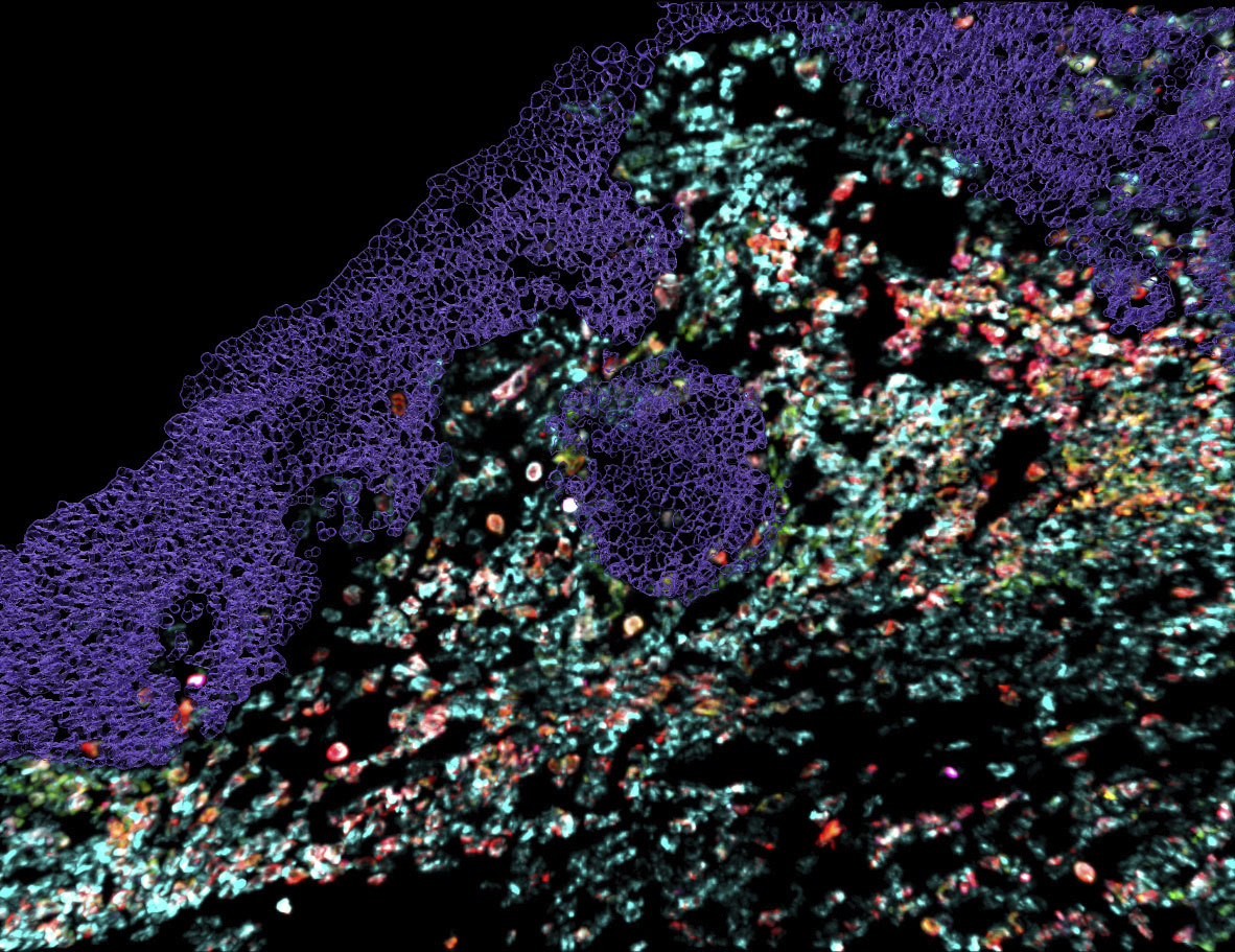 MANTIS spatial biology platform: image of the lymphoid panel performed on a Lupus patient. Data published in Science Advances