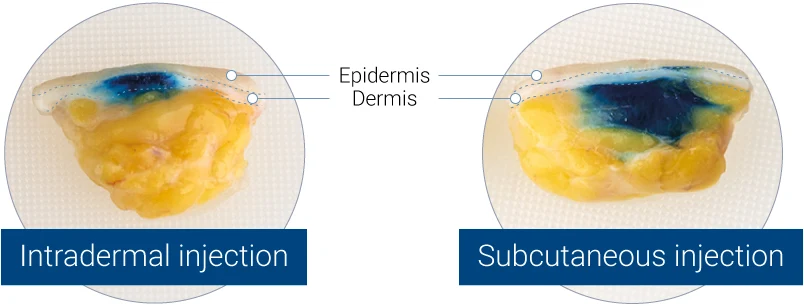 Intradermal (left panel) or subcutaneous (right panel) injection of blue dye into Genoskin’s human skin models. Split views of the model are presented.