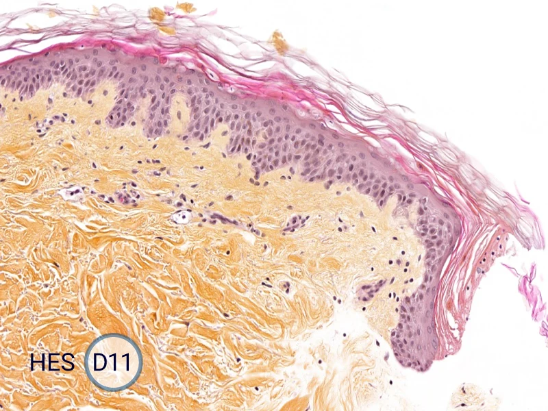 HES (Hematoxylin-Eosin-Safran) shows the progression of the epithelial tongue