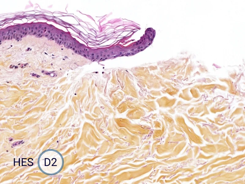 HES (Hematoxylin-Eosin-Safran) shows the progression of the epithelial tongue