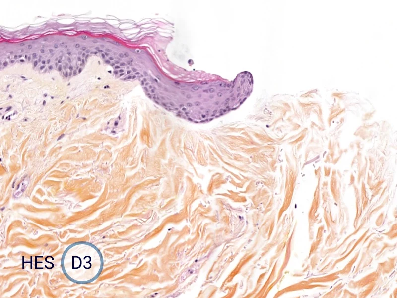 HES (Hematoxylin-Eosin-Safran) shows the progression of the epithelial tongue