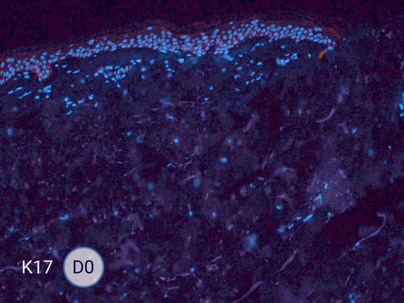 K17 specific marker of keratinocytes migrating over to wound bed