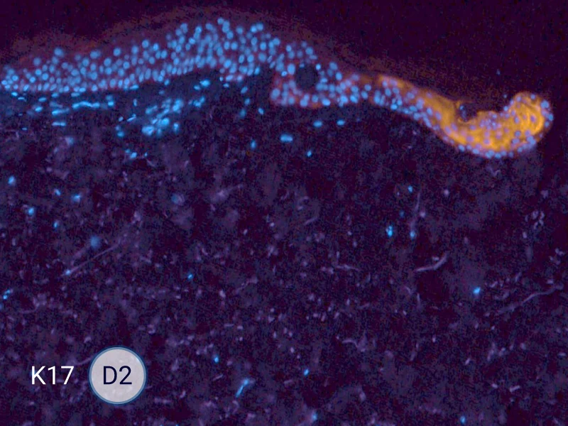 K17 specific marker of keratinocytes migrating over to wound bed