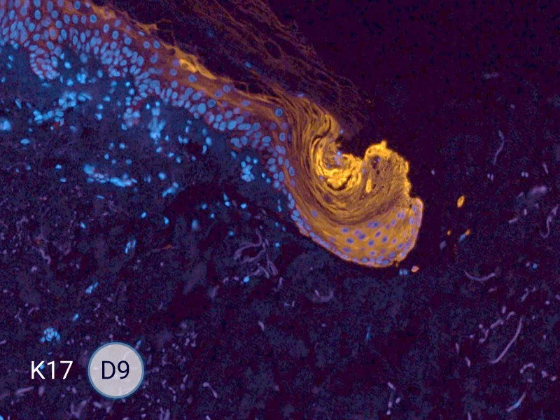 K17 specific marker of keratinocytes migrating over to wound bed