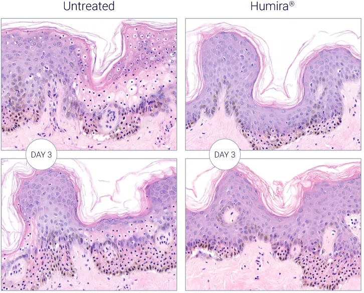 Humira Reduces Inflammation-Driven Damage in HS Models