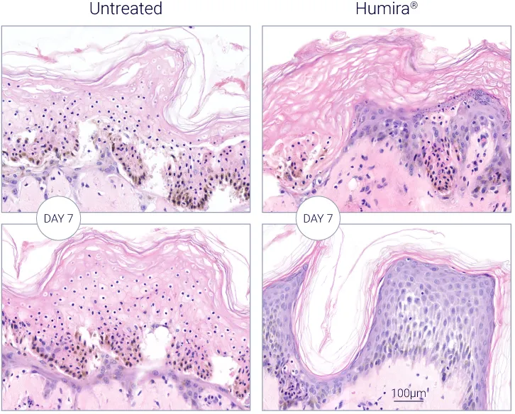 Humira Reduces Inflammation-Driven Damage in HS Models