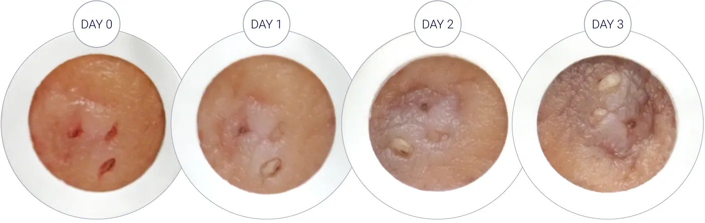 Ex Vivo Macroscopic Characterization and Biostabilization of Human HS Skin Models