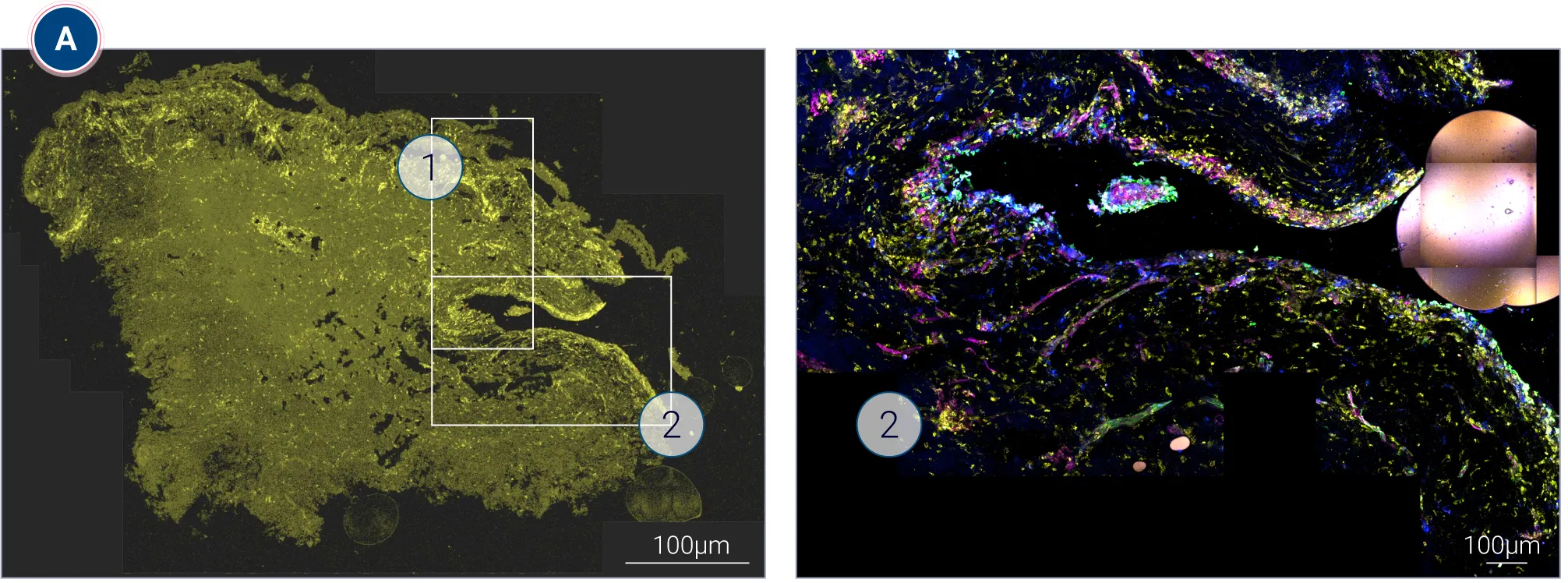 Spatial Biology and Digital Cell Mapping of Immune Infiltrates in Ex Vivo HS Lesions