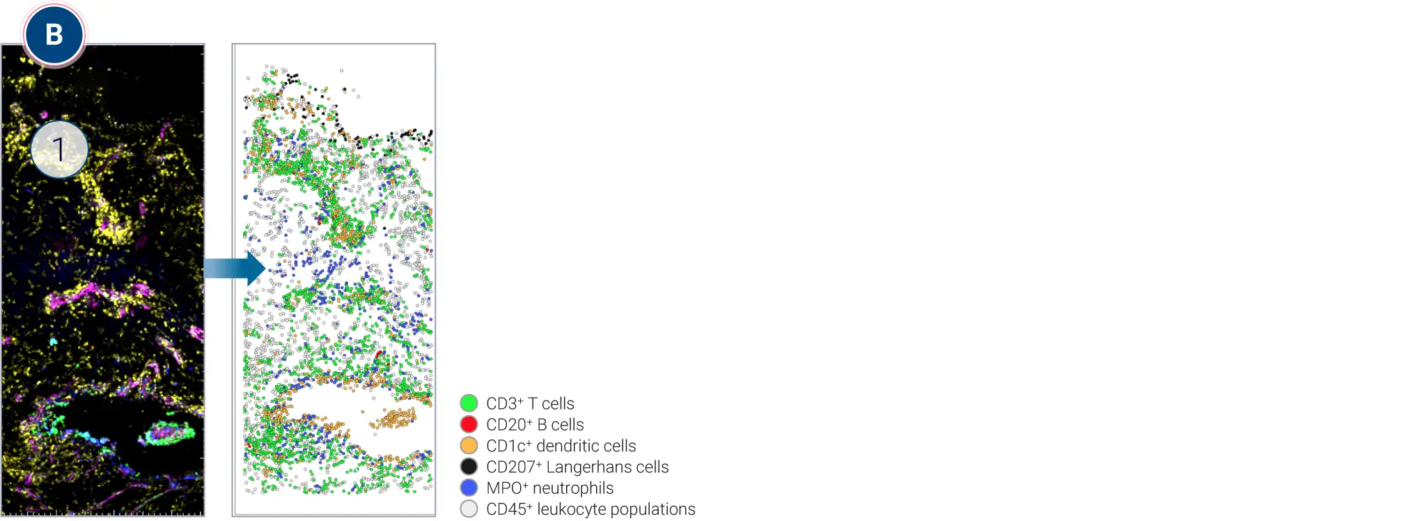 Spatial Biology and Digital Cell Mapping of Immune Infiltrates in Ex Vivo HS Lesions