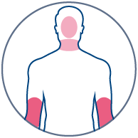 Picto-Atopic-dermatitis