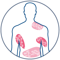 Picto-Psoriasis-v2